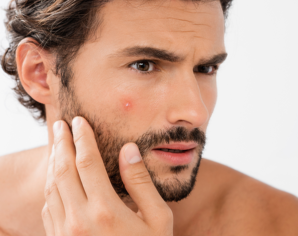homme bouton acnee peau